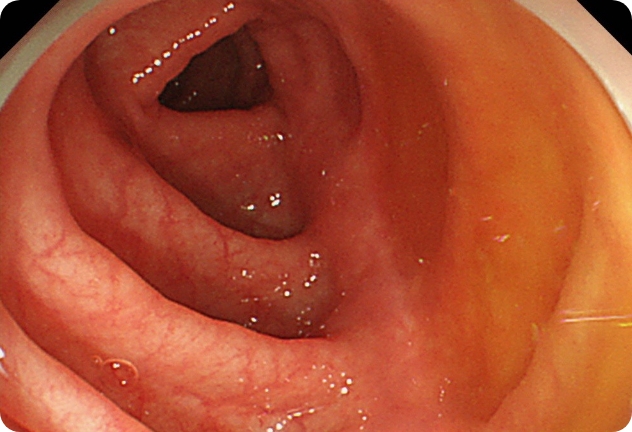 日帰りポリープ切除可
